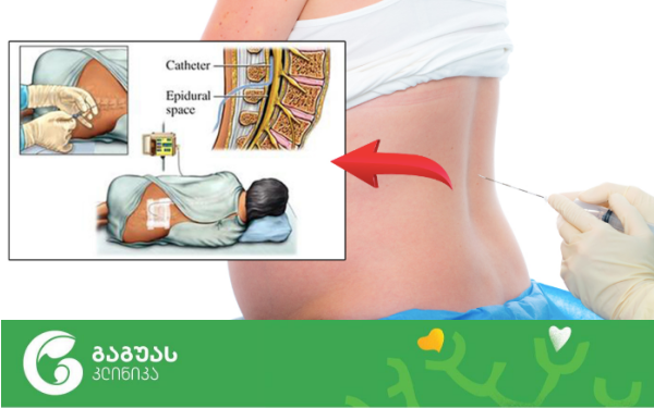 გაუტკივარება